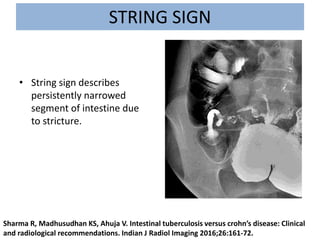 String Sign Crohns Disease
