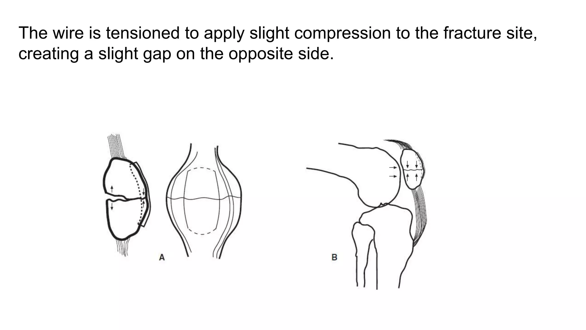 The wire is tensioned to apply slight compression to the fracture site,
creating a slight gap on the opposite side.
 