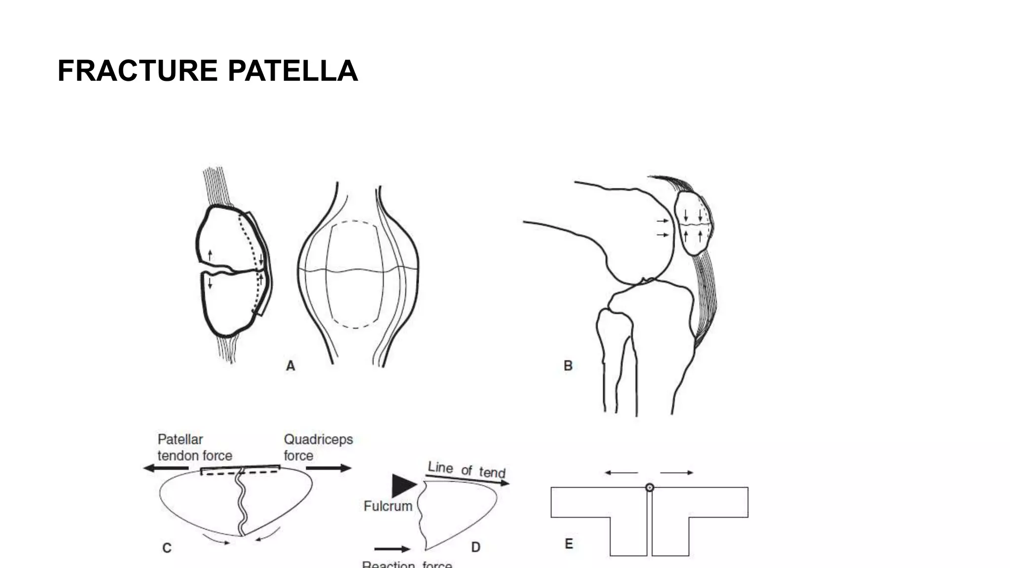 FRACTURE PATELLA
 