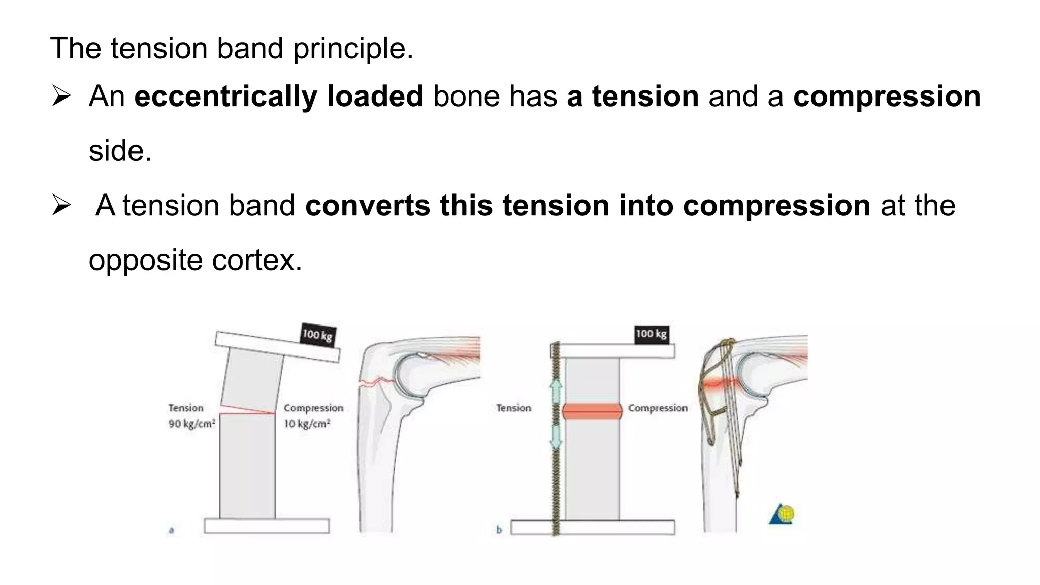 The tension band principle.
 An eccentrically loaded bone has a tension and a compression
side.
 A tension band converts this tension into compression at the
opposite cortex.
 