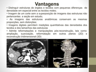 • Distinguir estruturas de órgãos e tecidos com pequenas diferenças de
densidade em especial entre os tecidos moles;
• Imagem de um corte sem a superposição de imagens das estruturas não
pertencentes a seção em estudo;
• As imagens das estruturas anatômicas conservam as mesmas
proporções, sem distorções;
• Imagens digitais permitem medições quantitativas das densidades dos
tecidos e dos tamanhos das estruturas
• Admite reformatações e manipulações pós-reconstrução, tais como:
ampliação, suavização, reformatação em outros planos (2D) e
reconstrução tridimensional (3D)
 