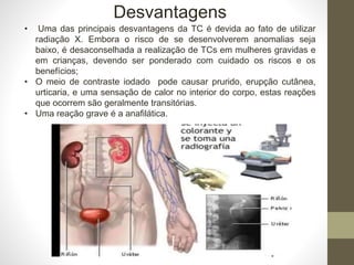 • Uma das principais desvantagens da TC é devida ao fato de utilizar
radiação X. Embora o risco de se desenvolverem anomalias seja
baixo, é desaconselhada a realização de TCs em mulheres gravidas e
em crianças, devendo ser ponderado com cuidado os riscos e os
benefícios;
• O meio de contraste iodado pode causar prurido, erupção cutânea,
urticaria, e uma sensação de calor no interior do corpo, estas reações
que ocorrem são geralmente transitórias.
• Uma reação grave é a anafilática.
Desvantagens
 