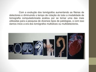 Com a evolução dos tomógrafos aumentando as fileiras de
detectores e diminuindo o tempo de rotação do tubo a modalidade de
tomografia computadorizada acabou por se tornar uma das mais
utilizadas para a pesquisa de diversos tipos de patologias, e com isso
damos inicio a era dos tomógrafos multislices ou multidetectores.
 
