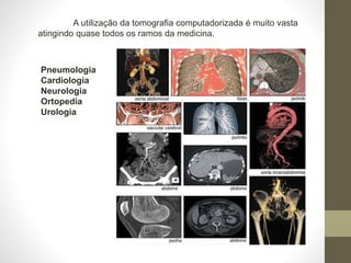 A utilização da tomografia computadorizada é muito vasta
atingindo quase todos os ramos da medicina.
Pneumologia
Cardiologia
Neurologia
Ortopedia
Urologia
 