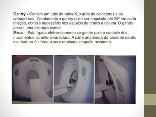 Gantry - Contem um tubo de raios X, o arco de detectores e os
colimadores. Geralmemte o gantry pode ser angulado até 30º em cada
direção, como é necessário nos estudos de cranio e coluna. O gantry
possui uma abertura central.
Mesa - Esta ligada eletronicamente ao gantry para o controle dos
movimentos durante a varredura. A parte anatômica do paciente dentro
da abertura é a área a ser examinada naquele momento.
 