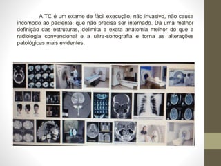 A TC é um exame de fácil execução, não invasivo, não causa
incomodo ao paciente, que não precisa ser internado. Da uma melhor
definição das estruturas, delimita a exata anatomia melhor do que a
radiologia convencional e a ultra-sonografia e torna as alterações
patológicas mais evidentes.
 