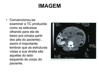 IMAGEM
• Convencionou-se
examinar a TC produzida
como se estivesse
olhando para ela de
baixo pra cima(a partir
dos pés do paciente) ,
assim é importante
lembrar que as estruturas
vistas a sua direita são
aquelas do lado
esquerdo do corpo do
paciente.
 