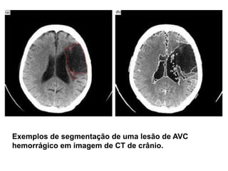 Exemplos de segmentação de uma lesão de AVC
hemorrágico em imagem de CT de crânio.
 