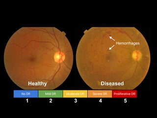 Healthy Diseased
Hemorrhages
No DR Mild DR Moderate DR Severe DR Proliferative DR
1 2 3 4 5
 