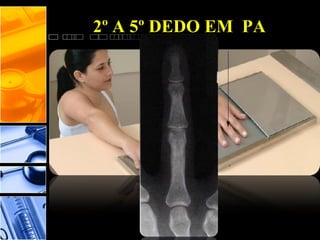 2º A 5º DEDO EM PA
 