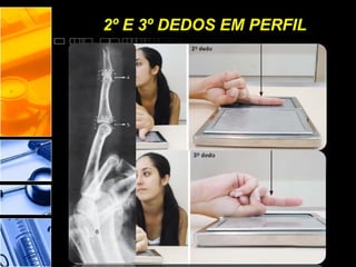 2º E 3º DEDOS EM PERFIL
 