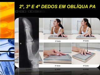 2º, 3º E 4º DEDOS EM OBLÍQUA PA
 
