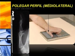 POLEGAR PERFIL (MÉDIOLATERAL)
 