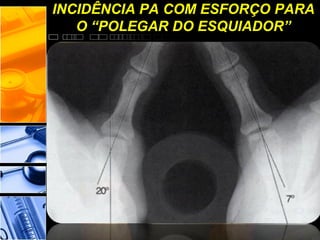 INCIDÊNCIA PA COM ESFORÇO PARA
O “POLEGAR DO ESQUIADOR”
 