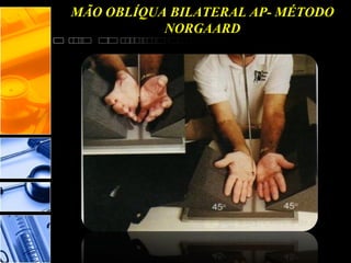 MÃO OBLÍQUA BILATERAL AP- MÉTODO
NORGAARD
 