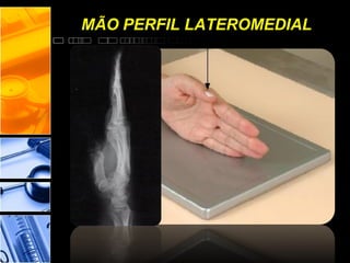 MÃO PERFIL LATEROMEDIAL
 