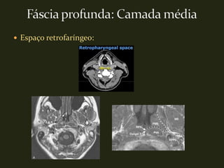  Espaço retrofaríngeo:
 