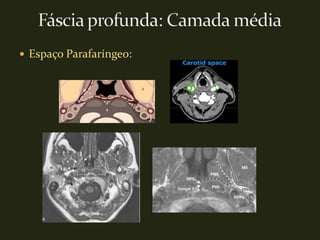 Espaço Parafaríngeo:
 