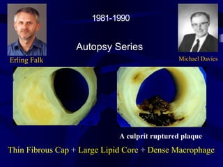 Erling Falk Michael Davies
Autopsy Series
Thin Fibrous Cap + Large Lipid Core + Dense Macrophage
A culprit ruptured plaque
1981-1990
 
