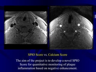 SPIO Score vs. Calcium Score
The aim of the project is to develop a novel SPIO
Score for quantitative monitoring of plaque
inflammation based on negative enhancement.
 