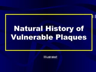 Natural History of
Vulnerable Plaques
Illustrated:
 
