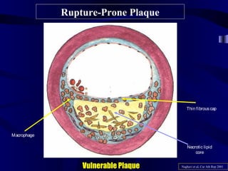 Rupture-Prone Plaque
Vulnerable Plaque Naghavi et al, Cur Ath Rep 2001
Macrophage
Necrotic lipid
core
Thin fibrouscap
 