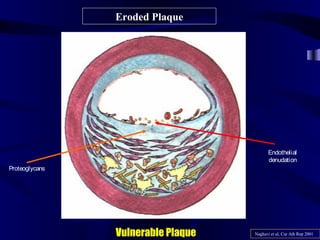 Eroded Plaque
Vulnerable Plaque Naghavi et al, Cur Ath Rep 2001
Endothelial
denudation
Proteoglycans
 