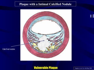 Plaque with a Intimal Calcified Nodule
Vulnerable Plaque Naghavi et al, Cur Ath Rep 2001
Calcified nodule
 