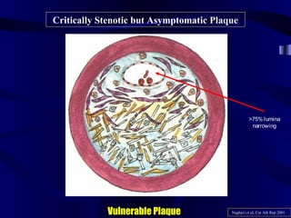 Critically Stenotic but Asymptomatic Plaque
Naghavi et al, Cur Ath Rep 2001Vulnerable Plaque
>75% lumina
narrowing
 