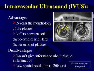 Intravascular Ultrasound (IVUS):
Advantage:
Reveals the morphology
of the plaque
Differs between soft
(hypo-echoic) and Hard
(hyper-echoic) plaques
Disadvantages:
Doesn’t give information about plaque
inflammation
Low spatial resolution (~ 200 µm)
Nissen, Yock, and
Fitzgerald
 
