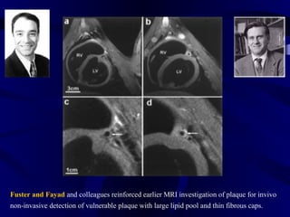 Fuster and Fayad and colleagues reinforced earlier MRI investigation of plaque for invivo
non-invasive detection of vulnerable plaque with large lipid pool and thin fibrous caps.
 