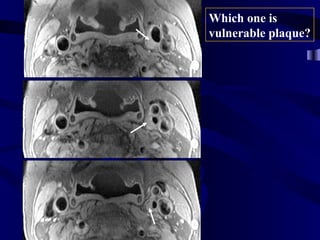 Which one is
vulnerable plaque?
 