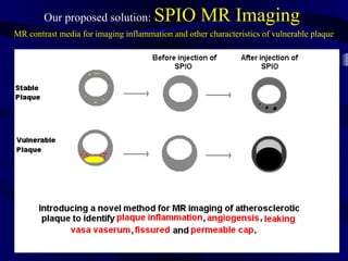 Our proposed solution: SPIO MR Imaging
MR contrast media for imaging inflammation and other characteristics of vulnerable plaque
 