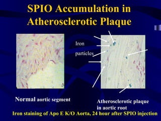 SPIO Accumulation in
Atherosclerotic Plaque
Atherosclerotic plaque
in aortic root
Normal aortic segment
Iron staining of Apo E K/O Aorta, 24 hour after SPIO injection
Iron
particles
 