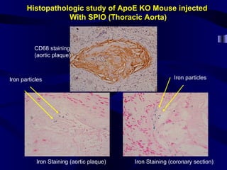 Histopathologic study of ApoE KO Mouse injected
With SPIO (Thoracic Aorta)
CD68 staining
(aortic plaque)
Iron Staining (aortic plaque) Iron Staining (coronary section)
Iron particles Iron particles
 