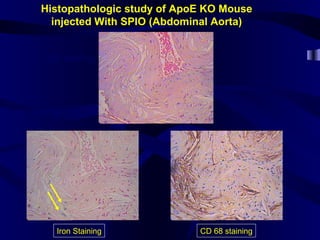 Histopathologic study of ApoE KO Mouse
injected With SPIO (Abdominal Aorta)
H&E staining
Iron Staining CD 68 staining
Iron particles
 