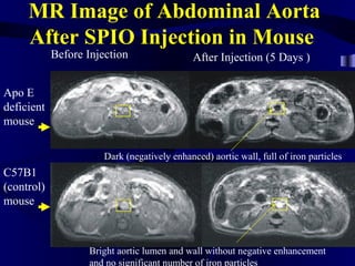 MR Image of Abdominal Aorta
After SPIO Injection in Mouse
Apo E
deficient
mouse
C57B1
(control)
mouse
Before Injection After Injection (5 Days )
Dark (negatively enhanced) aortic wall, full of iron particles
Bright aortic lumen and wall without negative enhancement
and no significant number of iron particles
 