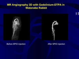 MR Angiography 3D with Gadolinium-DTPA in
Watanabe Rabbit
Before SPIO injection After SPIO injection
 