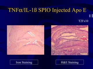 T2Fx10
TNFα/IL-1ß SPIO Injected Apo E
Iron Staining H&E Staining
 