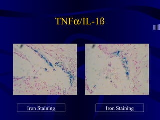 TNFα/IL-1ß
Iron Staining Iron Staining
 