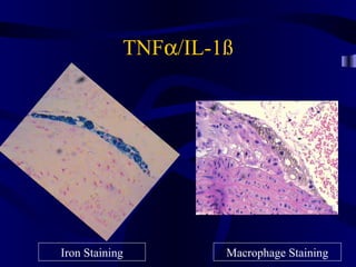 TNFα/IL-1ß
Iron Staining Macrophage Staining
 