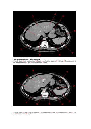 Corte axial de abdômen (TAC). Imagem 1.
1, Pulmão direito. 2, veia hepática direita. 3, Fígado. 4, veia hepática esquerda. 5, Estômago. 6, flexura esquerda do
colo (flexura esplênica). 7, Baço. 8, Pulmão esquerdo. 9, Aorta.




1, Pulmão direito. 2, Aorta. 3, Pulmão esquerdo. 4, Adrenal esquerda. 5, Baço. 6, Artéria esplênica. 7, Colon. 8, Veia
porta. 9,Veia hepática. 10, Fígado.
 