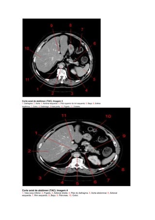 Corte axial de abdômen (TAC). Imagem 3
1, Diafragma. 2, Aorta. 3, Adrenal esquerda. 4, Pólo superior do rim esquerdo. 5, Baço. 6, Artéria
esplênica. 7, Colon. 8, Estômago. 9,Veia porta. 10, Fígado. 11, Costela.




Corte axial de abdômen (TAC). Imagem 4
1, Veia cava inferior. 2, Fígado. 3, Adrenal direita. 4, Pilar do diafragma. 5, Aorta abdominal. 6, Adrenal
esquerda. 7, Rim esquerdo. 8, Baço. 9, Pâncreas. 10, Colon.
 