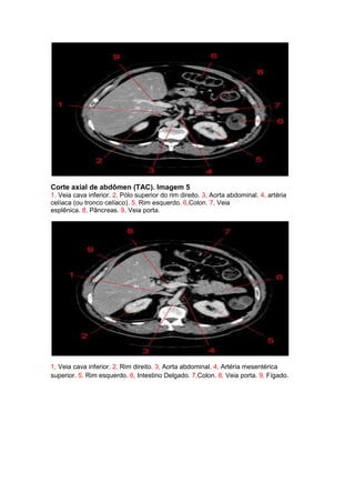 Corte axial de abdômen (TAC). Imagem 5
1, Veia cava inferior. 2, Pólo superior do rim direito. 3, Aorta abdominal. 4, artéria
celíaca (ou tronco celíaco). 5, Rim esquerdo. 6,Colon. 7, Veia
esplênica. 8, Pâncreas. 9, Veia porta.




1, Veia cava inferior. 2, Rim direito. 3, Aorta abdominal. 4, Artéria mesentérica
superior. 5, Rim esquerdo. 6, Intestino Delgado. 7,Colon. 8, Veia porta. 9, Fígado.
 