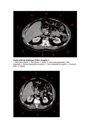 Corte axial de abdômen (TAC). Imagem 7
1, Veia cava inferior. 2, Rim direito. 3, Aorta. 4, Veia renal esquerda.5, Rim
esquerdo. 6, Artéria mesentérica superior. 7, Veia mesentérica superio. 8, Vesícula
biliar. 9, Fígado.
 