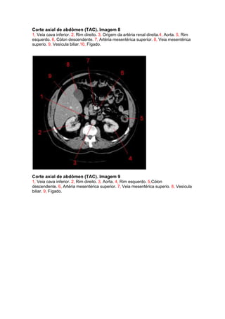 Corte axial de abdômen (TAC). Imagem 8
1, Veia cava inferior. 2, Rim direito. 3, Origem da artéria renal direita.4, Aorta. 5, Rim
esquerdo. 6, Cólon descendente. 7, Artéria mesentérica superior. 8, Veia mesentérica
superio. 9, Vesícula biliar.10, Fígado.




Corte axial de abdômen (TAC). Imagem 9
1, Veia cava inferior. 2, Rim direito. 3, Aorta. 4, Rim esquerdo. 5,Cólon
descendente. 6, Artéria mesentérica superior. 7, Veia mesentérica superio. 8, Vesícula
biliar. 9, Fígado.
 