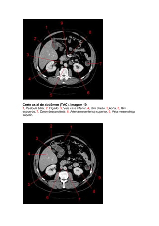 Corte axial de abdômen (TAC). Imagem 10
1, Vesícula biliar. 2, Fígado. 3, Veia cava inferior. 4, Rim direito. 5,Aorta. 6, Rim
esquerdo. 7, Cólon descendente. 8, Artéria mesentérica superior. 9, Veia mesentérica
superio.
 