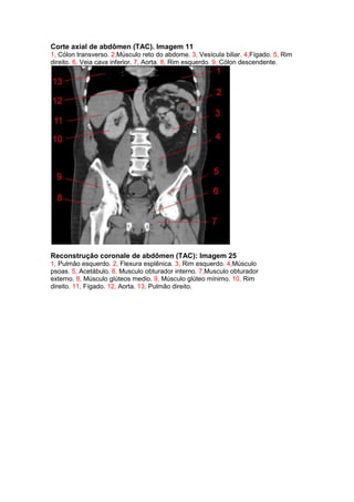 Corte axial de abdômen (TAC). Imagem 11
1, Cólon transverso. 2,Músculo reto do abdome. 3, Vesícula biliar. 4,Fígado. 5, Rim
direito. 6, Veia cava inferior. 7, Aorta. 8, Rim esquerdo. 9, Cólon descendente.




Reconstrução coronale de abdômen (TAC): Imagem 25
1, Pulmão esquerdo. 2, Flexura esplênica. 3, Rim esquerdo. 4,Músculo
psoas. 5, Acetábulo. 6, Musculo obturador interno. 7,Musculo obturador
externo. 8, Músculo glúteos medio. 9, Músculo glúteo mínimo. 10, Rim
direito. 11, Fígado. 12, Aorta. 13, Pulmão direito.
 