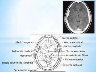 Tercer ventrículo 
Lóbulo anterior de cerebelo 
Ventrículo lateral 
Núcleo caudado 
Acueducto del Silvio 
Lóbulo temporal 
Cuerpo calloso 
Colículo superior 
Seno sagital superior 
Hipocampo 
Pedúnculo cerebral 
Cisterna ambient  