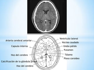 Ventrículo lateral 
Arteria cerebral anterior 
Calcificación de la glándula pineal 
Hoz del cerebro 
Núcleo caudado 
Putamen 
Capsula interna 
Tálamo 
Globo pálido 
Plexo coroideo 
Hoz del cerebro  